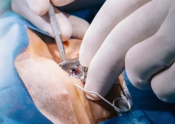 Cirurgia de catarata sendo realizada com microscópio no centro cirúrgico do HOA
